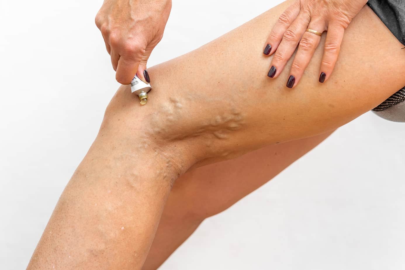 Remedii populare din revizuirile picioarelor varicose, Tratament remedii populare picior varicose